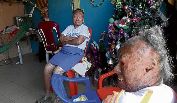 Los hermanos con piel de pez